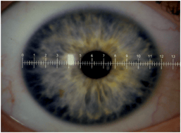 Technique 2: Slit Lamp & Reticle