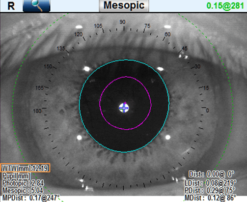 White-to-white (WTW) measurement with the OPD III