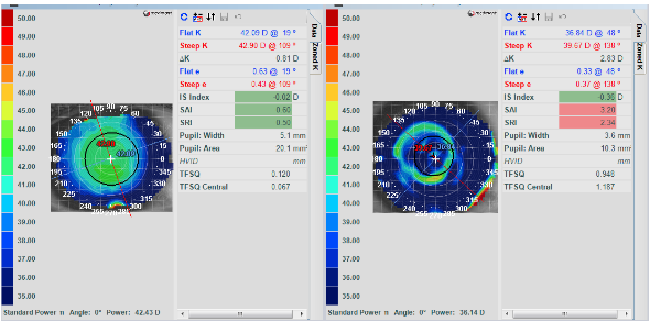 baseline and over topography maps of right eye