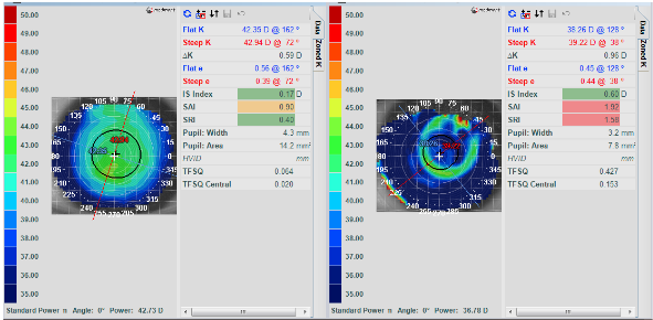 Baseline and over topography maps of left eye