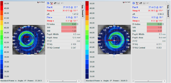 Over topography maps using distance center multifocal with OptiSync technology