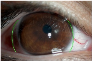 Flat Custom Soft Contact Lens with Poor Centration