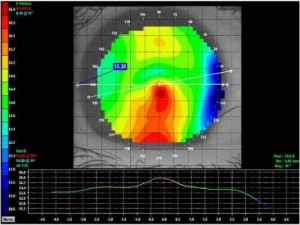  Improve custom soft contact lenses with HVID measurement 