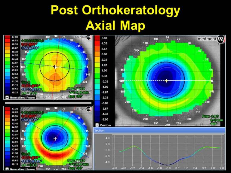 Post Othro-K Axial Map