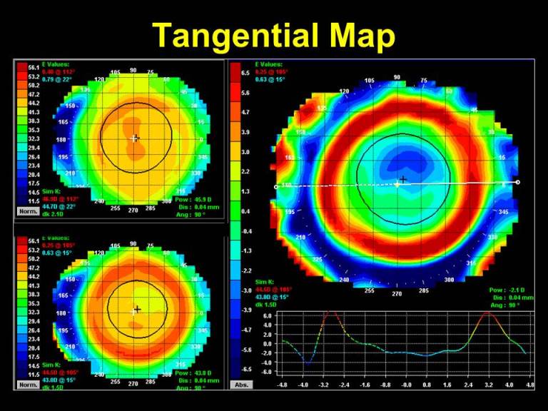 Myopia: Tangential Map