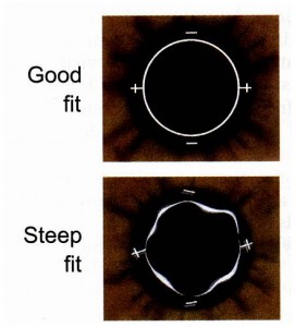 Over Keratometry of Toric Contact Lenses