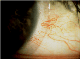 Tight Lens Affecting Conjunctiva