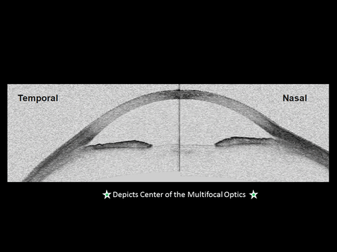 Multifocal optics shift temporally due to scleral shape