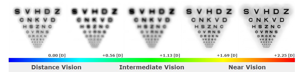 The far-left image of Simulation #2 demonstrates, decreasing the peripheral zone to 3.5mm enhanced distance vision significantly. The patient’s distance vision improved from 20/50 OU with the trial lenses to 20/25 OU with the second set of toric multifocal contact lenses.