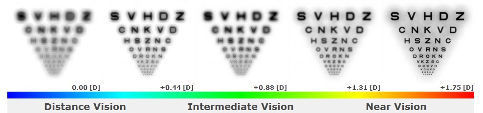 The improvement illustrated in Simulations #3 and #4 corresponded directly to the patient’s improved visual acuities with the second set of trial multifocal toric contact lenses, which were designed using the Multifocal Simulator. Distance visual acuity improved from 20/30 to 20/20- and near visual acuity from J4 to J1 at the final follow-up visit. 