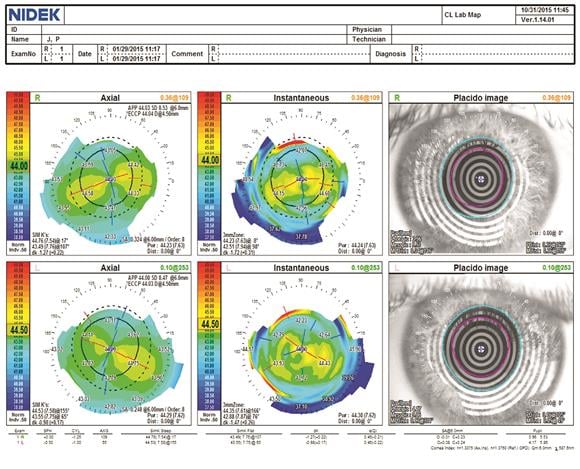 Nidek Topography Results