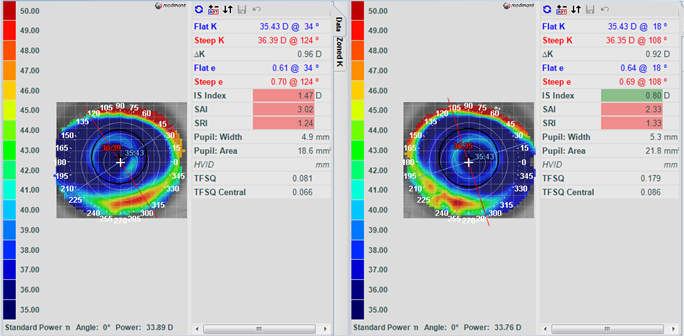 myopia 2