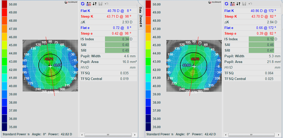 Figure 1. Baseline corneal topographies (axial map) of the right eye (left) and of the left eye (right) performed by Medmont E300 topography. The black solid circle shown in the middle represents the pupil size in each eye. 